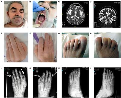 Clinicopathological Relationships in an Aged Case of DOORS Syndrome With a p.Arg506X Mutation in the ATP6V1B2 Gene